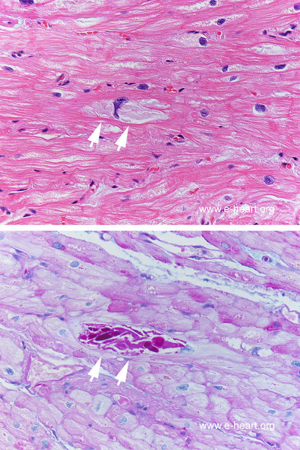 Glycogen PRKAG2